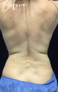 Exilis Radio Frequency