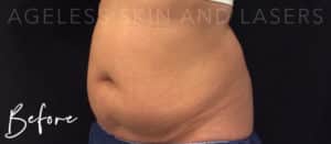 Exilis Radio Frequency