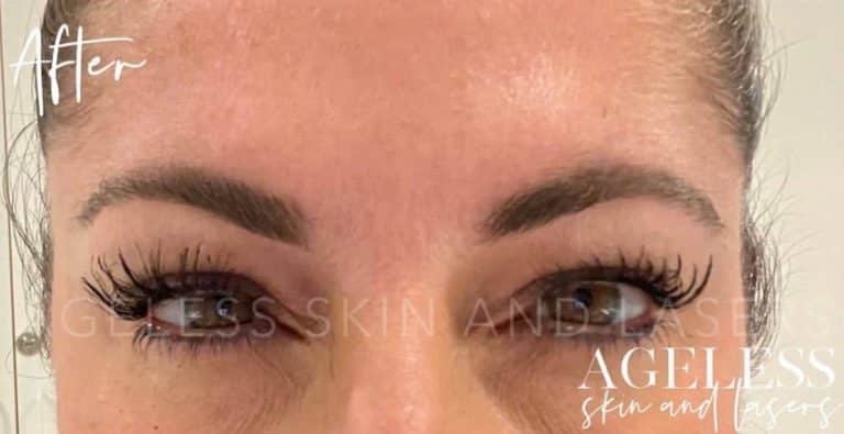 After Image: BOTOX - front