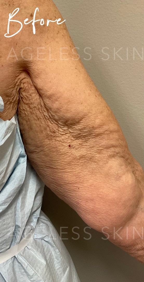 Before Image: Exilis Radio Frequency - front