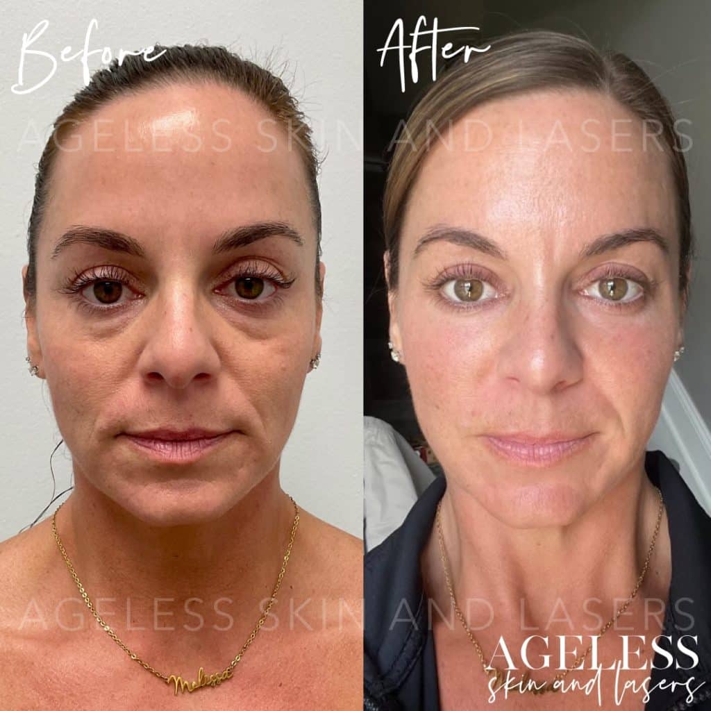 Platelet Rich Fibrin (PRF) - Ageless Skin and Lasers