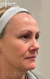 Before Image: Liquid Face Lift with Dermal Filler