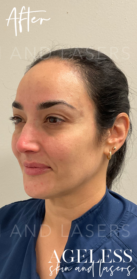 After Image: Facial Balancing with Dermal Filler - left-front-oblique