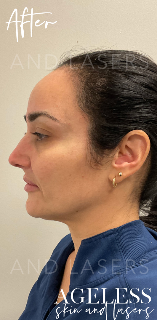 After Image: Facial Balancing with Dermal Filler - left-side