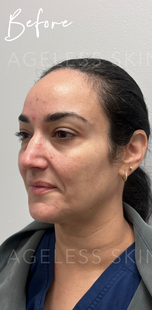 Before Image: Facial Balancing with Dermal Filler - left-front-oblique