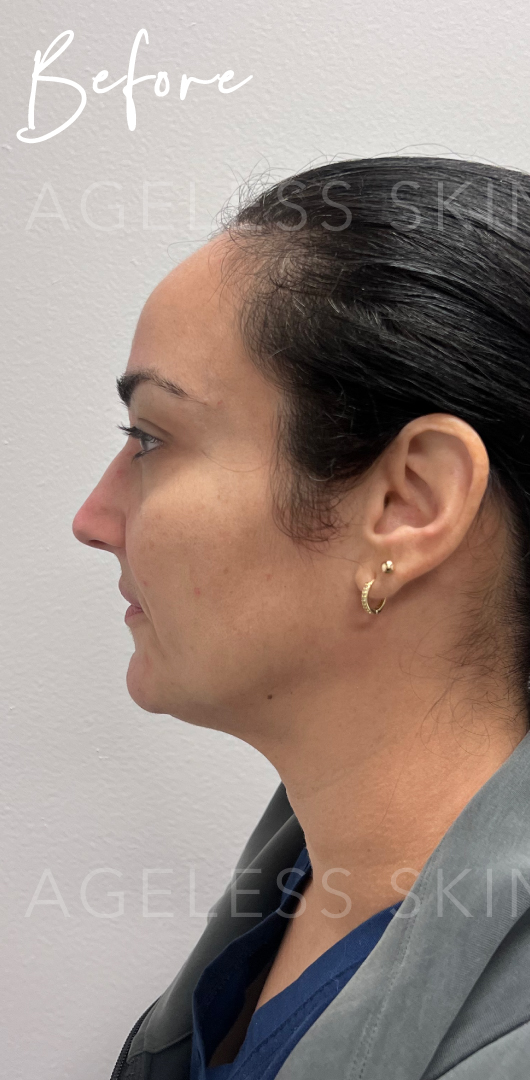 Before Image: Facial Balancing with Dermal Filler - left-side