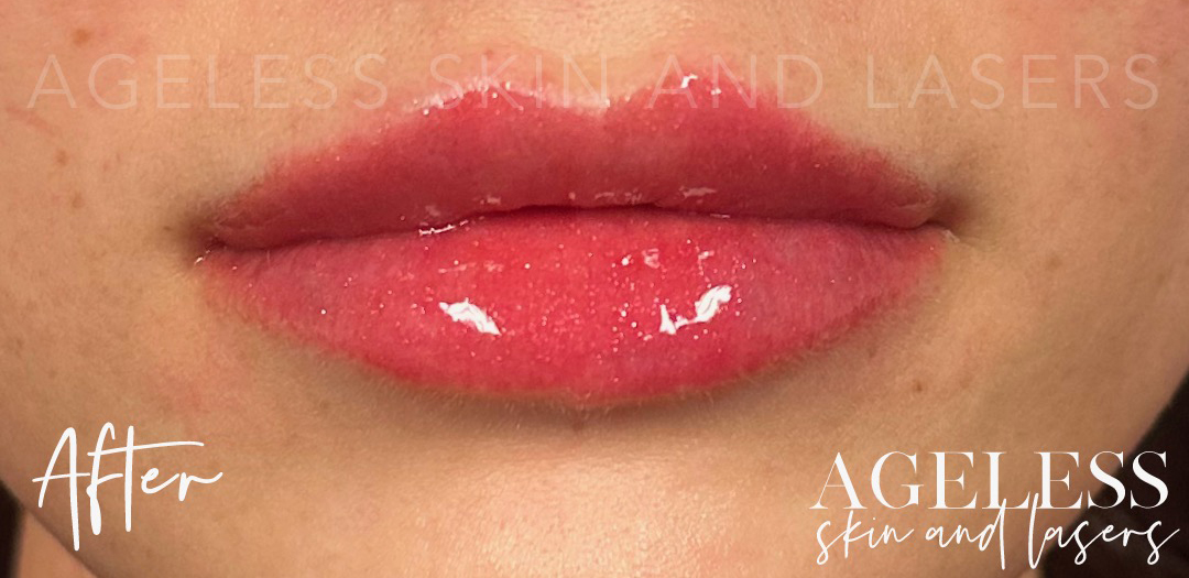 After Image: Lip Filler - front