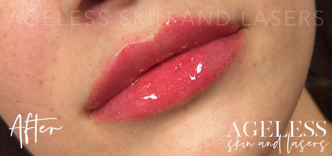 After Image: Lip Filler - right-front-oblique