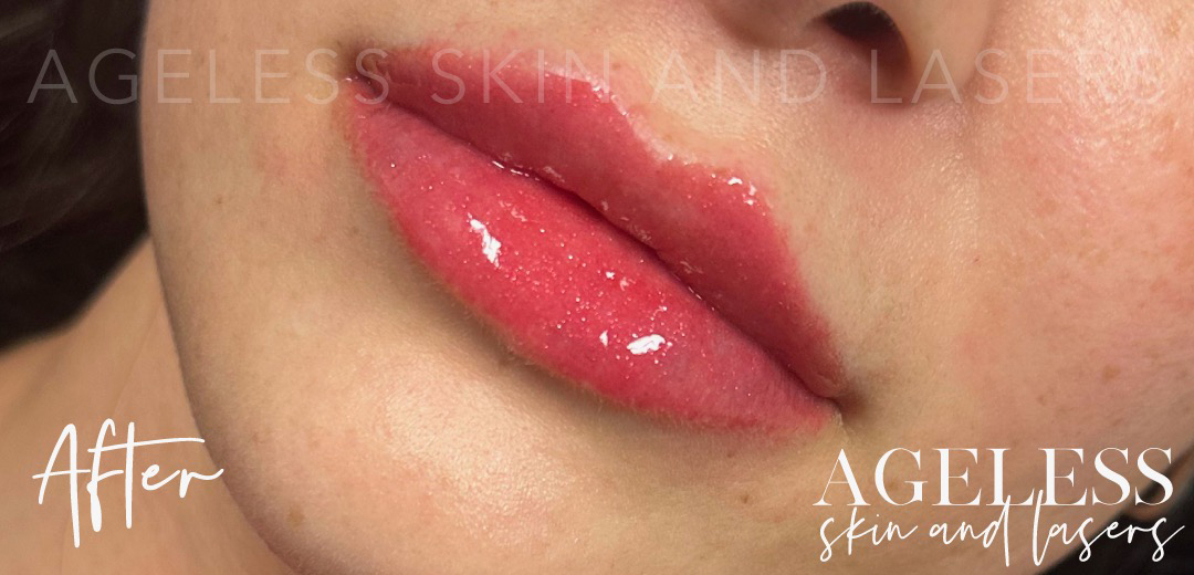 After Image: Lip Filler - left-front-oblique