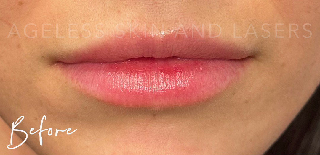 Before Image: Lip Filler - front