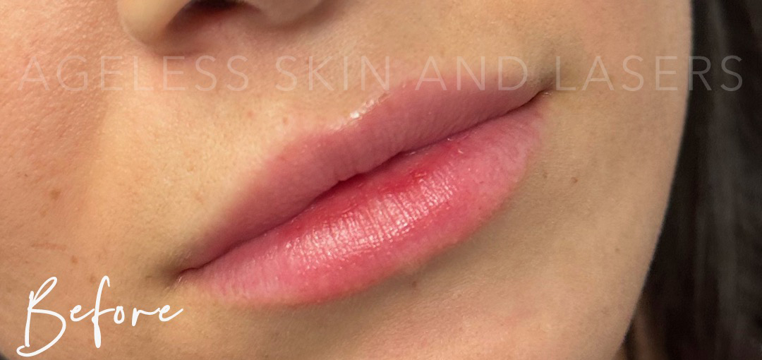 Before Image: Lip Filler - right-front-oblique