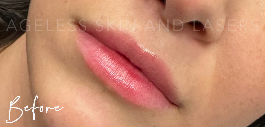 Before Image: Lip Filler - left-front-oblique