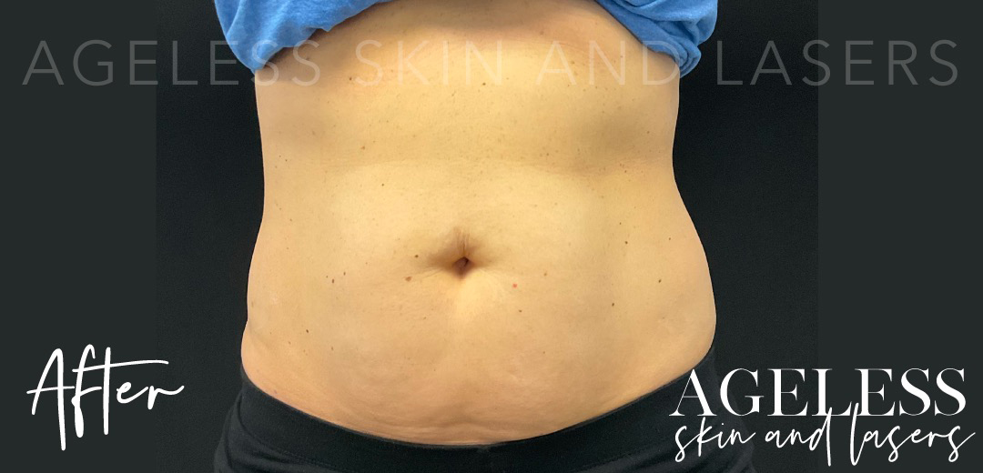After Image: EmSculpt Neo - front