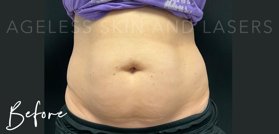 Before Image: EmSculpt Neo - front