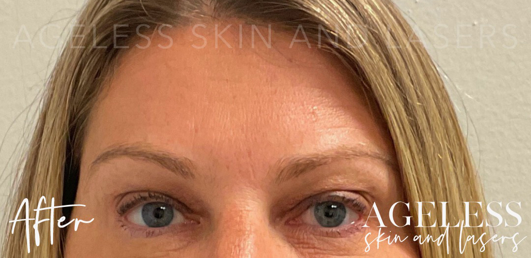 After Image: Dermal Filler in 11 Lines - front