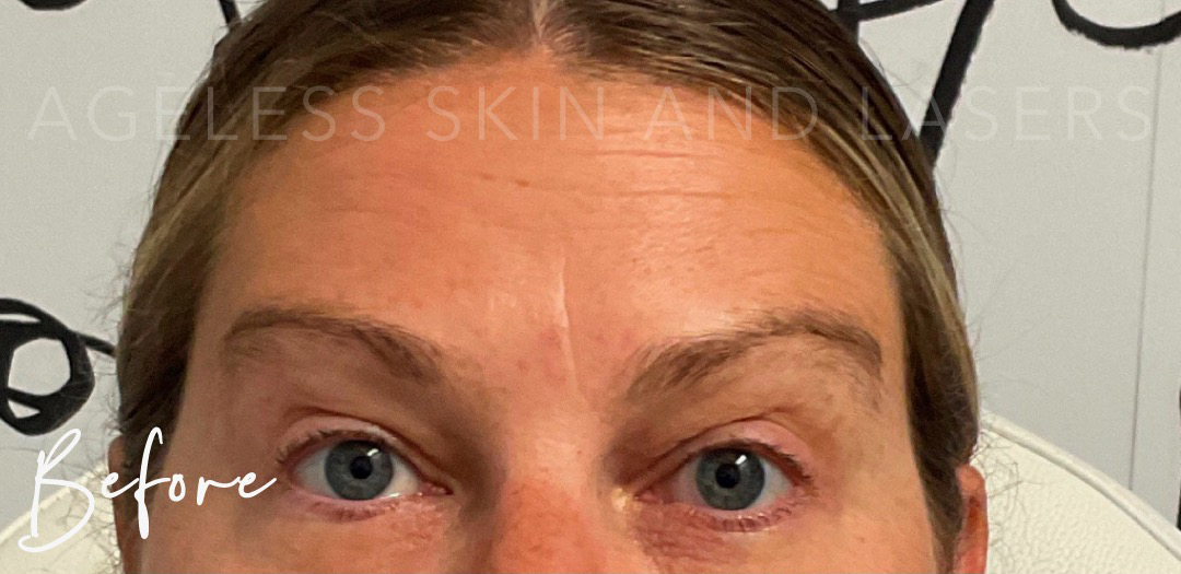 Before Image: Dermal Filler in 11 Lines - front