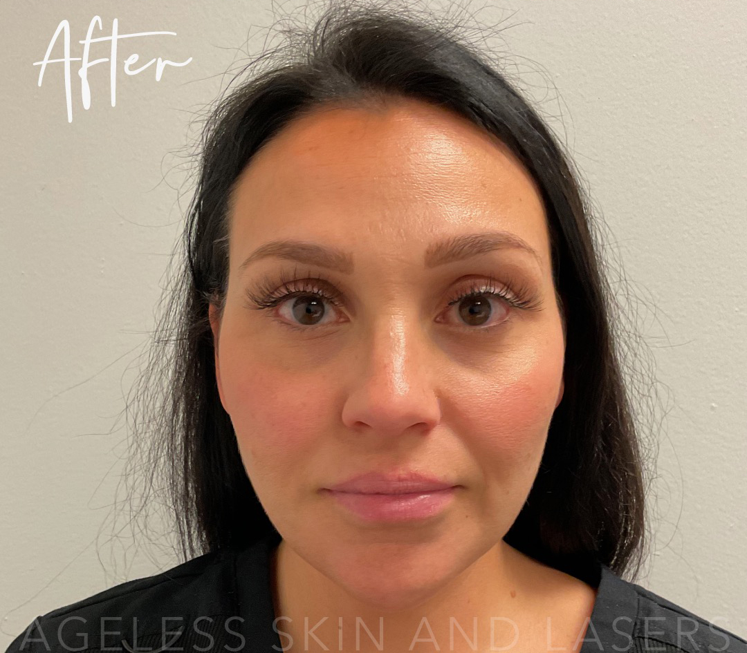 After Image: Full Facial Balancing with Dermal Filler - front