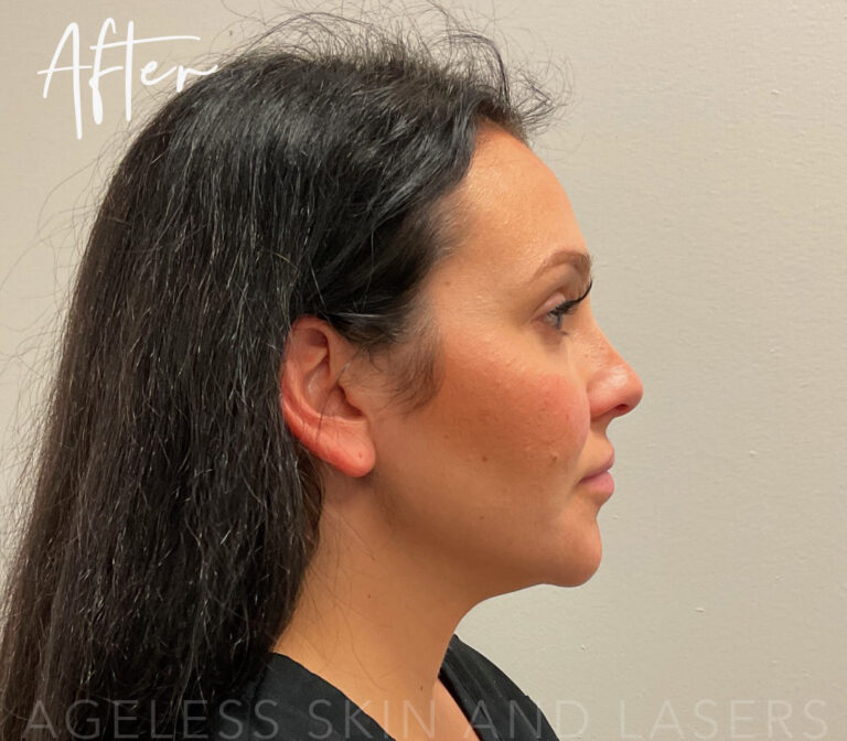 After Image: Full Facial Balancing with Dermal Filler - right-side