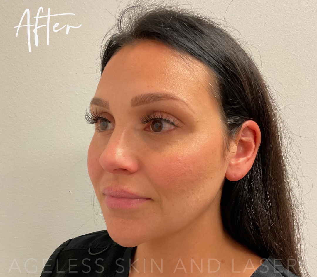 After Image: Full Facial Balancing with Dermal Filler - left-front-oblique