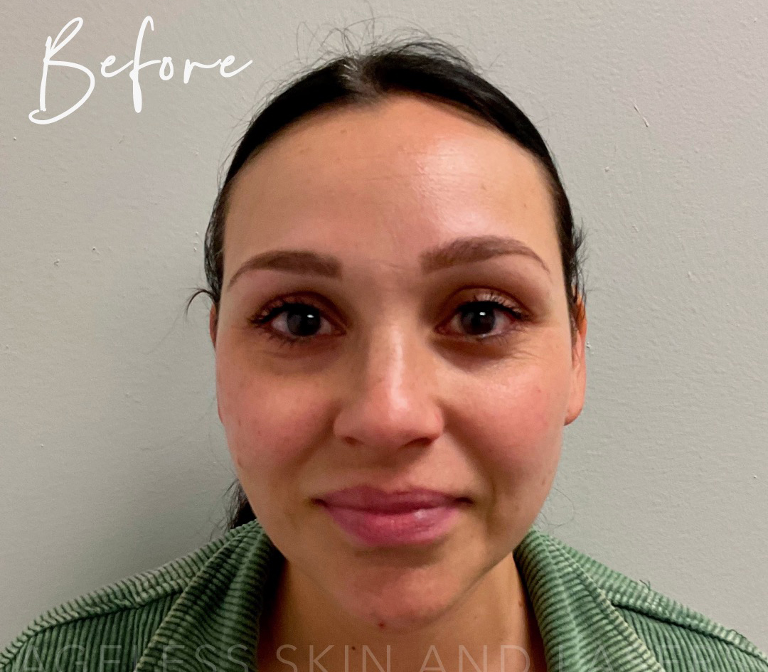 Before Image: Full Facial Balancing with Dermal Filler - front