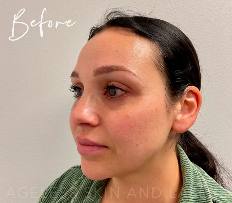 Before Image: Full Facial Balancing with Dermal Filler - left-front-oblique