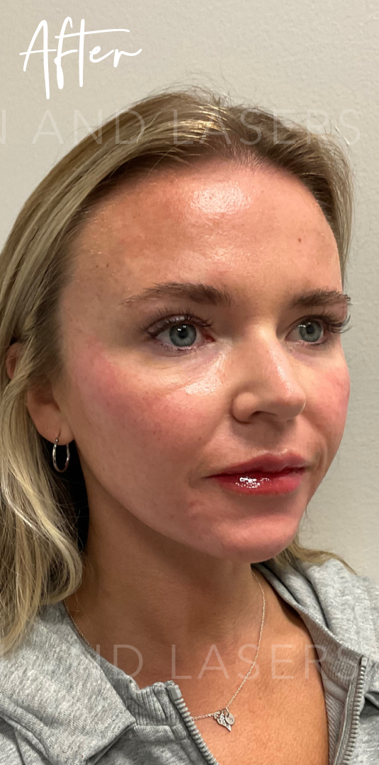 After Image: Full Facial Balancing with Dermal Filler - right-front-oblique