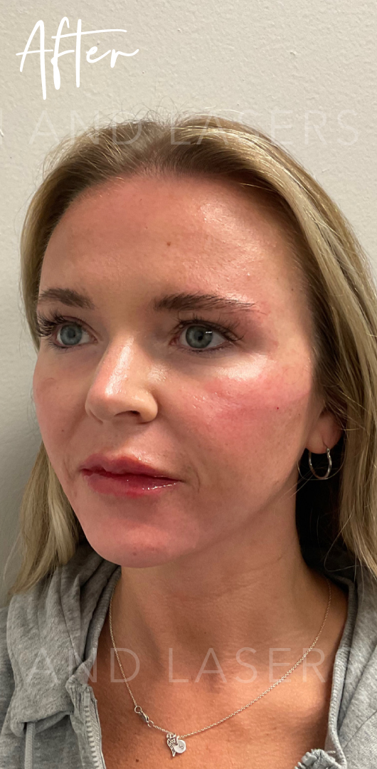 After Image: Full Facial Balancing with Dermal Filler - left-front-oblique