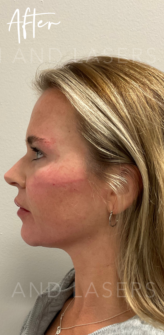 After Image: Full Facial Balancing with Dermal Filler - left-side