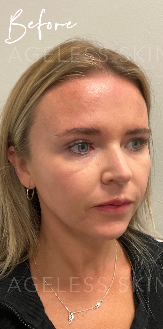 Before Image: Full Facial Balancing with Dermal Filler - right-front-oblique