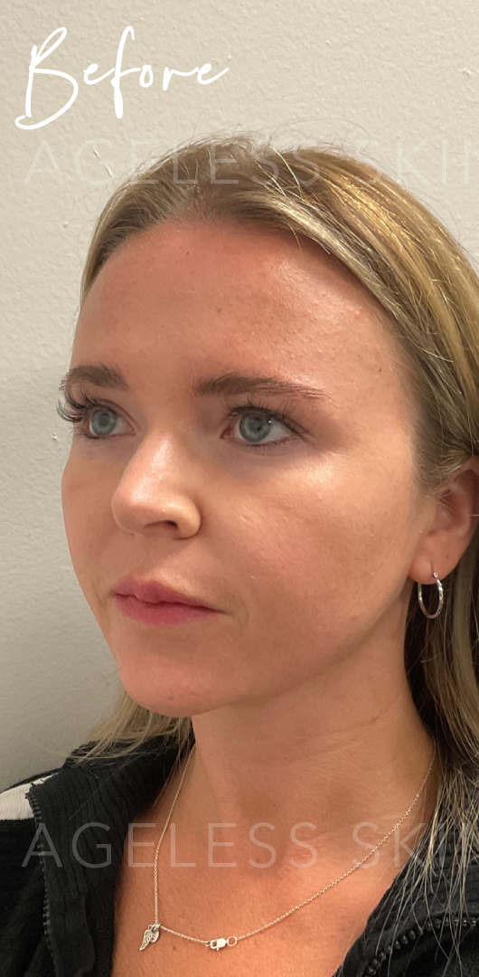 Before Image: Full Facial Balancing with Dermal Filler - left-front-oblique