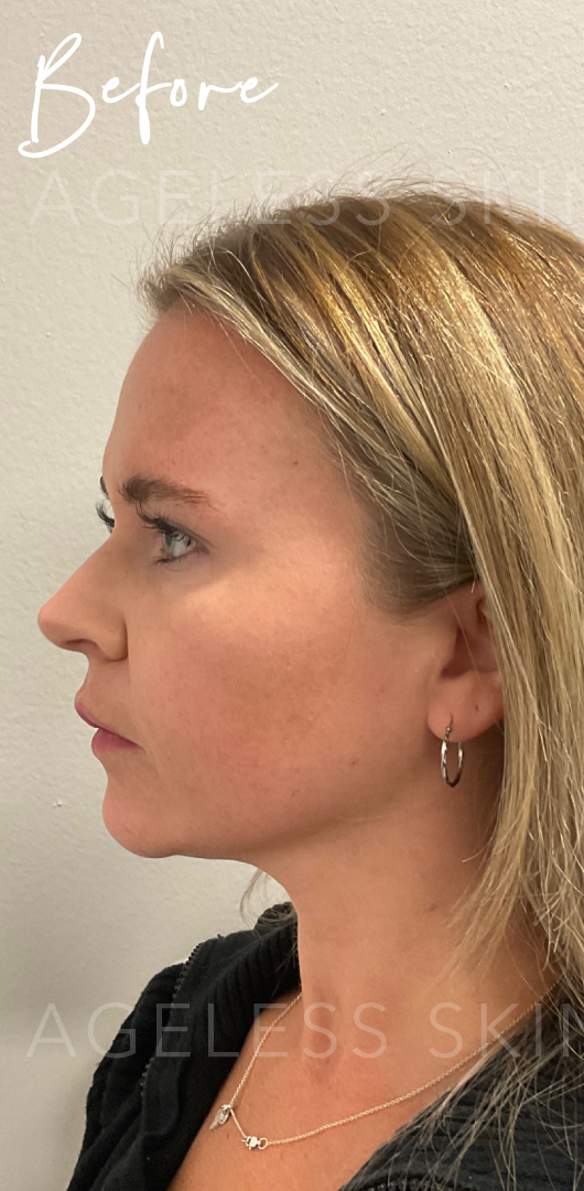 Before Image: Full Facial Balancing with Dermal Filler - left-side
