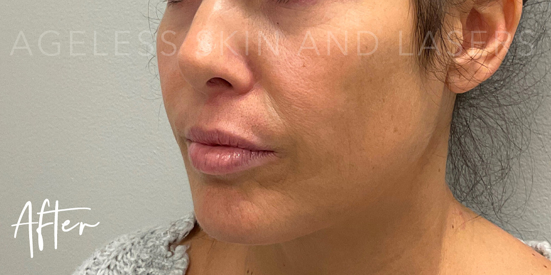 After Image: Microneedling & Dermal Filler - left-front-oblique