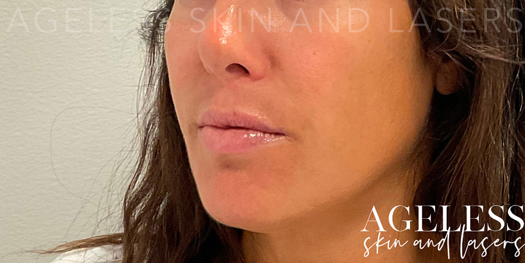 Before Image: Microneedling & Dermal Filler - left-front-oblique