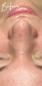 Hydrafacial