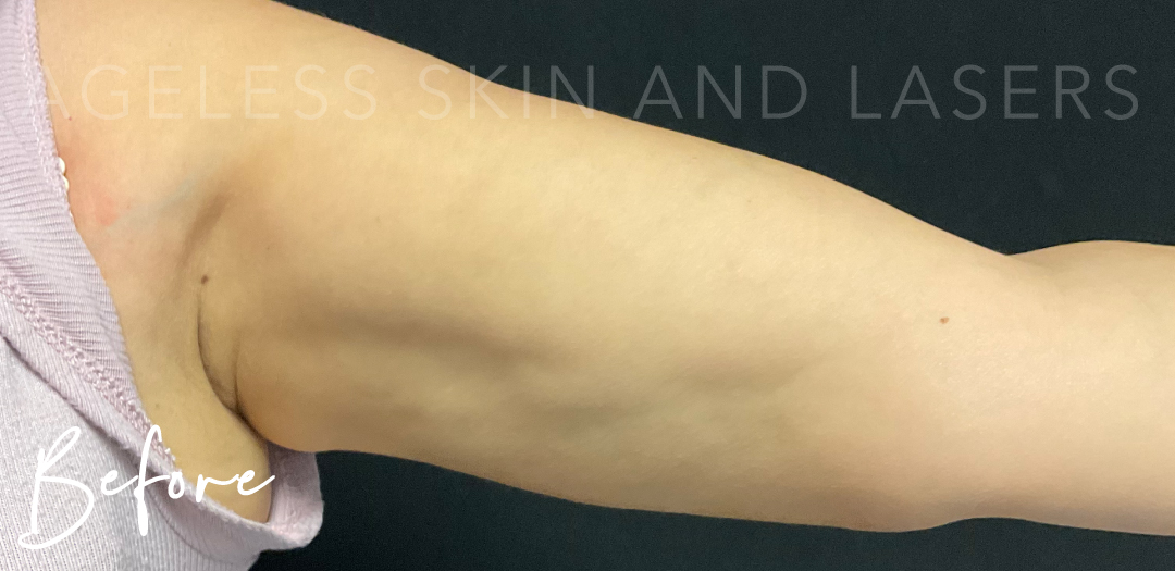 Before Image: Emsculpt Neo - front