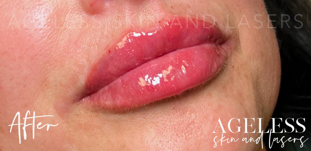 After Image: Lip Filler - right-front-oblique
