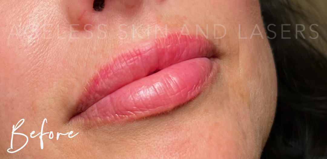 Before Image: Lip Filler - right-front-oblique