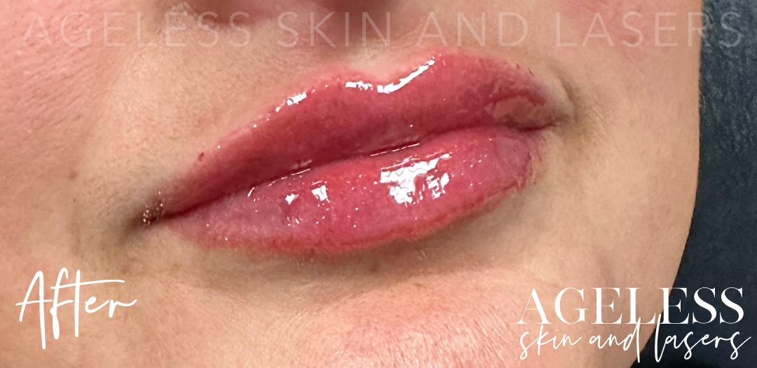 After Image: Lip Filler - right-front-oblique