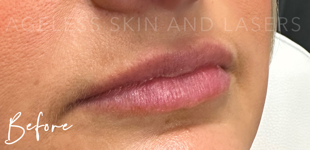 Before Image: Lip Filler - right-front-oblique