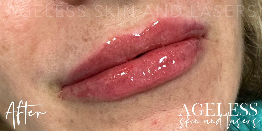 After Image: Lip Filler - right-front-oblique