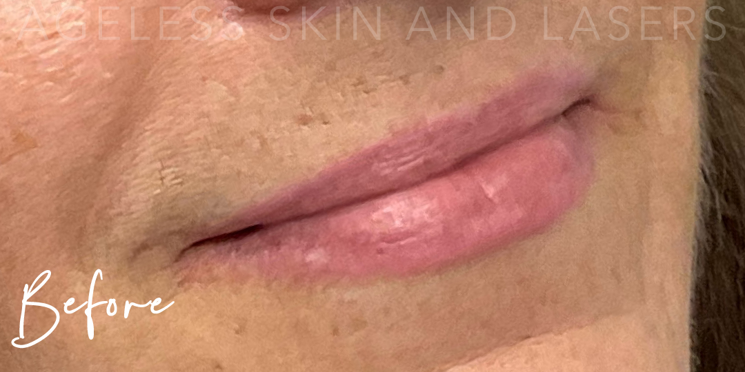Before Image: Lip Filler - right-front-oblique