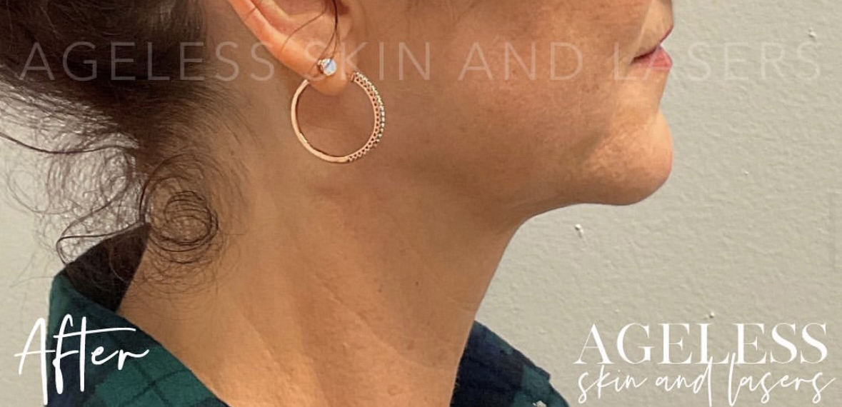 After Image: RF Microneedling - right-side