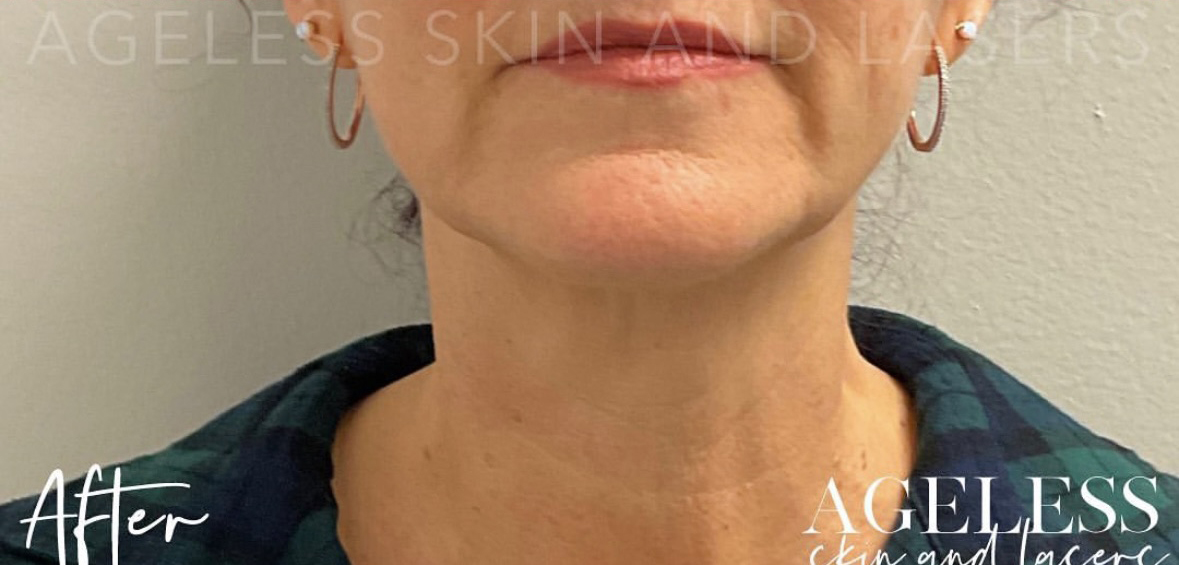 After Image: RF Microneedling - front