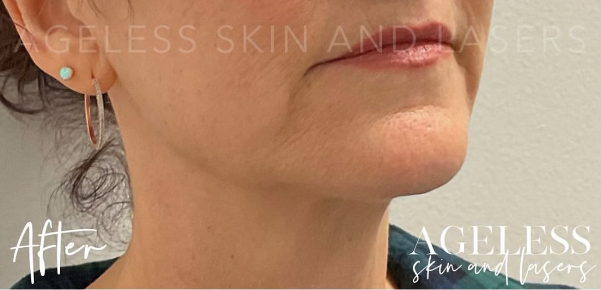 After Image: RF Microneedling - right-front-oblique