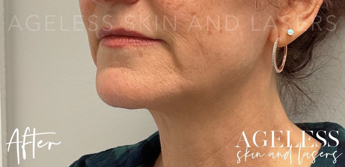 After Image: RF Microneedling - left-front-oblique