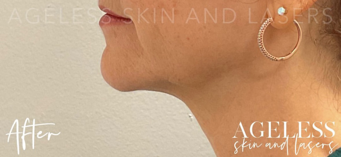 After Image: RF Microneedling - left-side