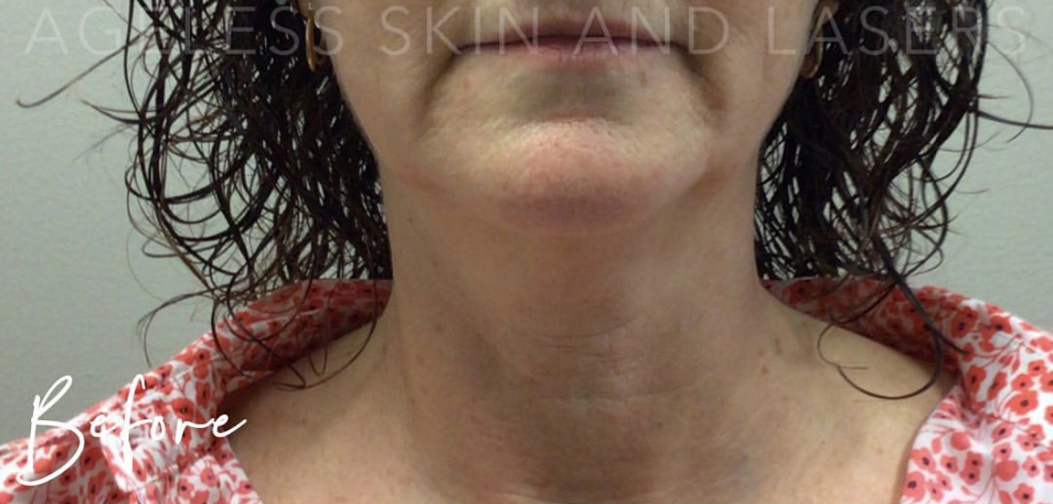 Before Image: RF Microneedling - front