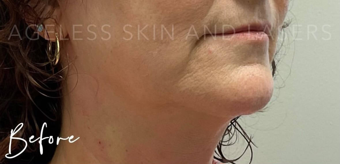 Before Image: RF Microneedling - right-front-oblique