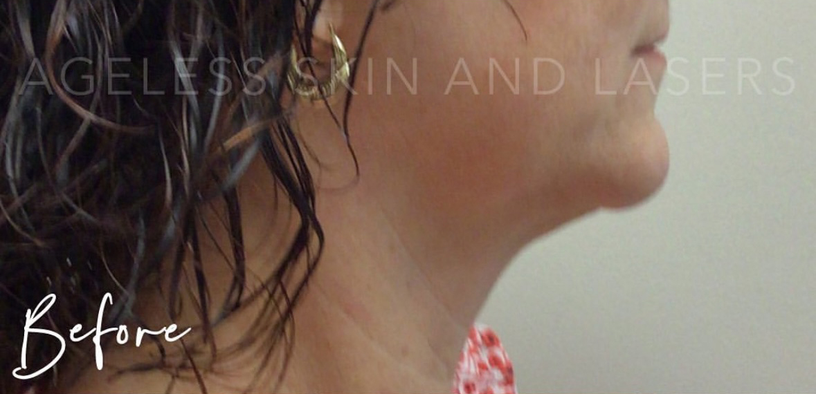 Before Image: RF Microneedling - right-side