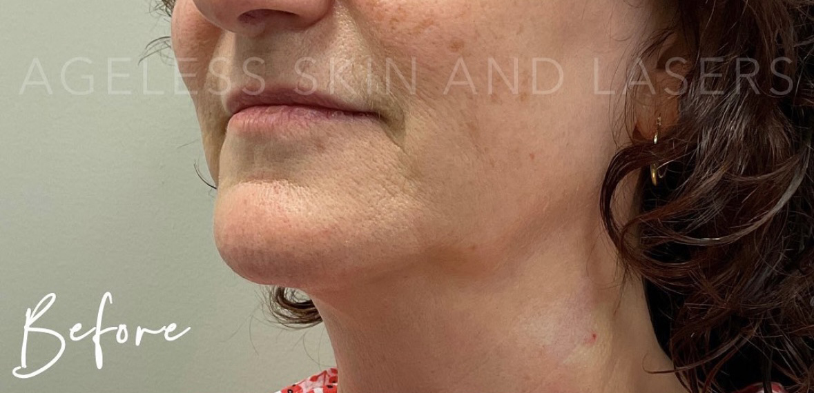 Before Image: RF Microneedling - left-front-oblique